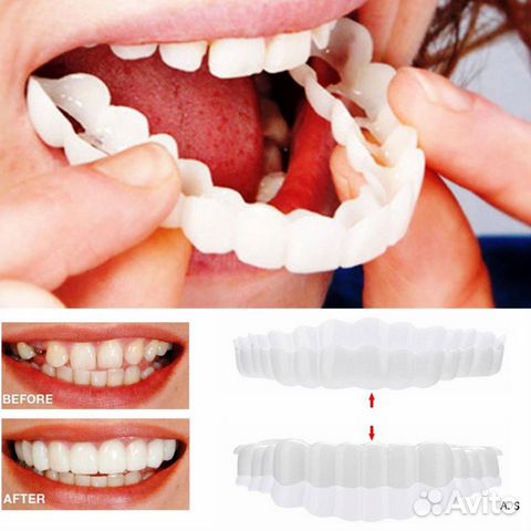 Виниры Snap-On smile Виниры Snap-On smile