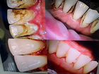 Чистка зубов (Проф гигиена)
